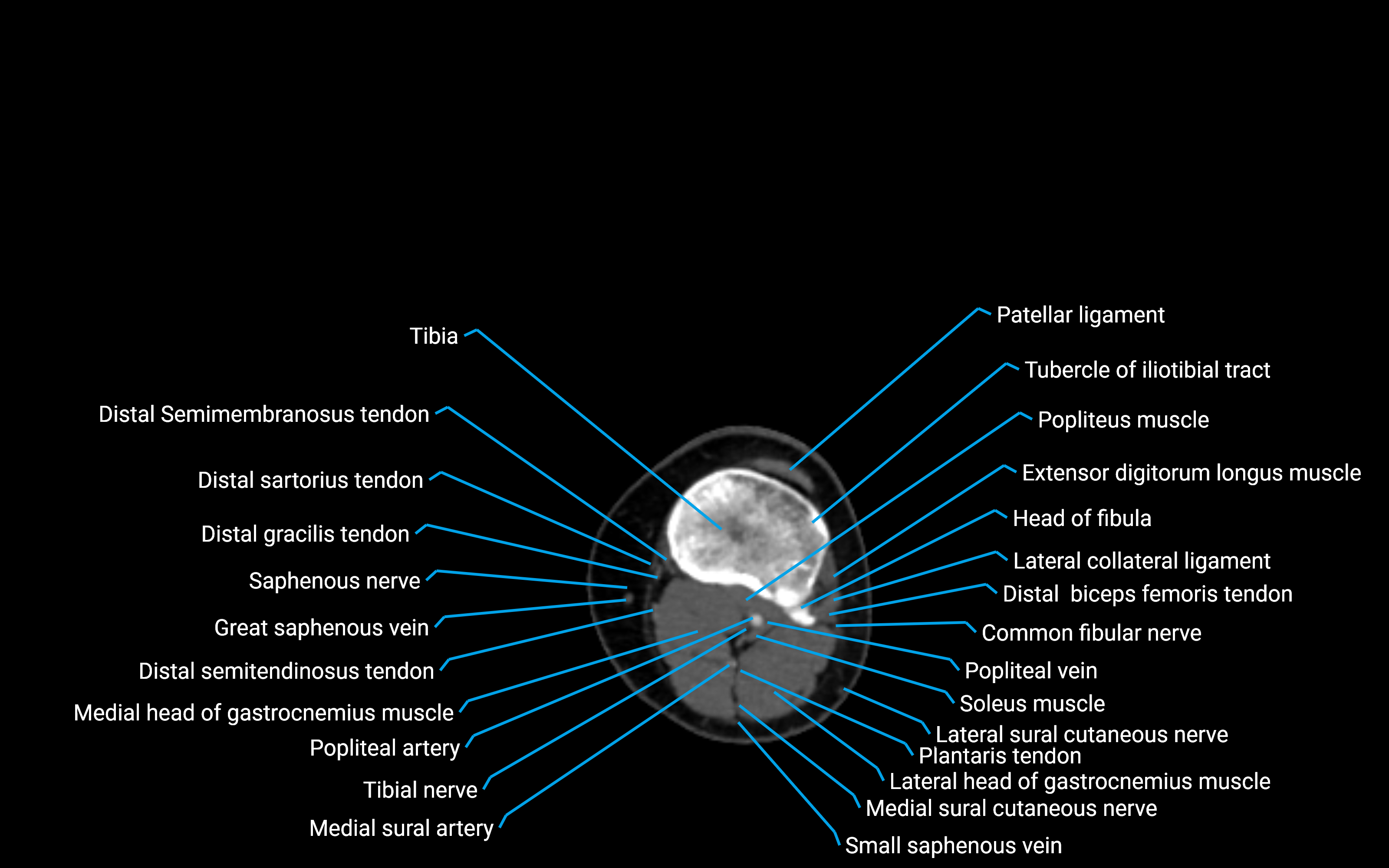 CT Lower leg axial cross sectional anatomy labelled image 94 (2).png